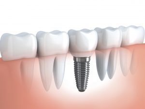 Dental implants and cosmetic dentistry in London at affordable prices. 