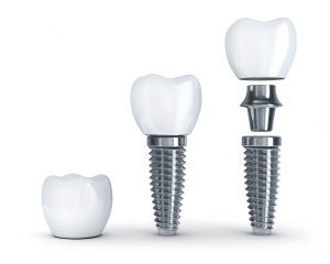 Are you missing a single tooth? One implant and a crown can replace it. A dental implant replaces both the lost natural tooth and its root.