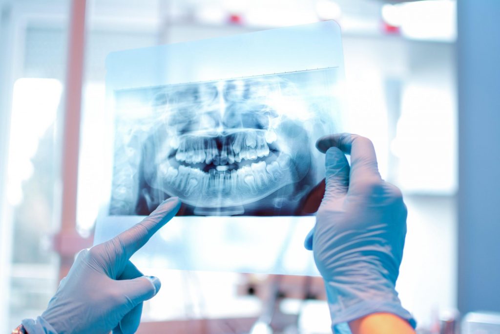 implant retained dentures are becoming the new treatment choice for patients looking to replace their dentures