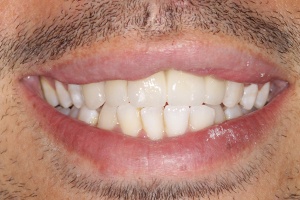 after single implant