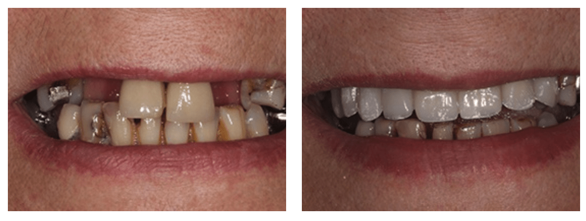 patient requires multiple dental implants to restore gaps