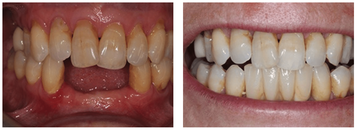 client that required dental implants in the lower jaw to replace missing teeth