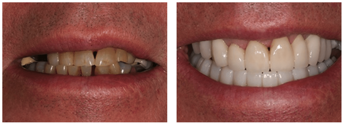 veneers in claygate can restore your smile