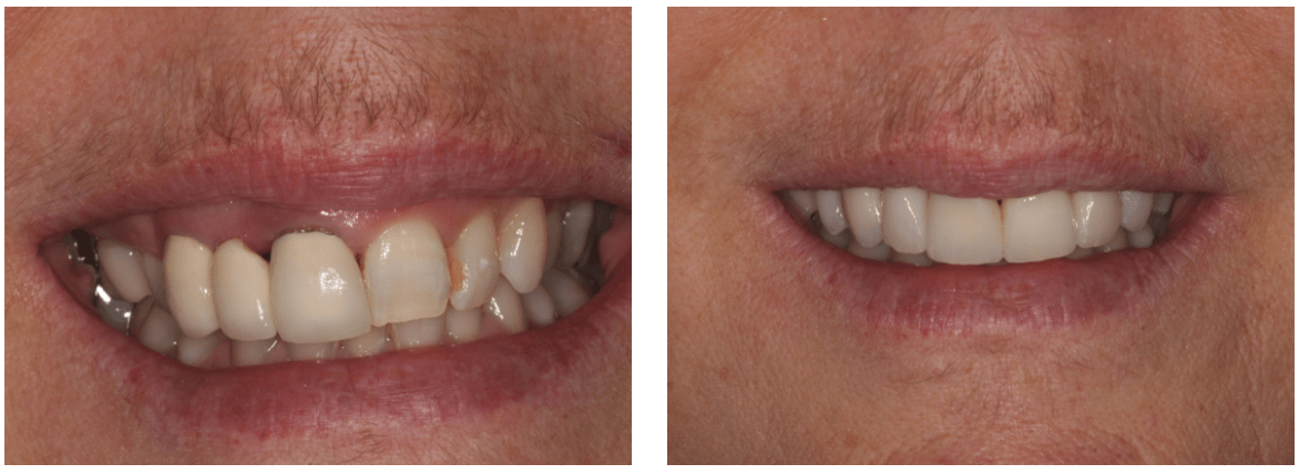 Patient receives dental implant restorative work to repair the upper jaw