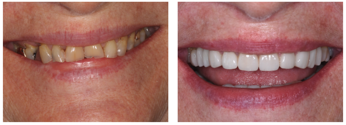 Veneers are used to restore a gleaming smile