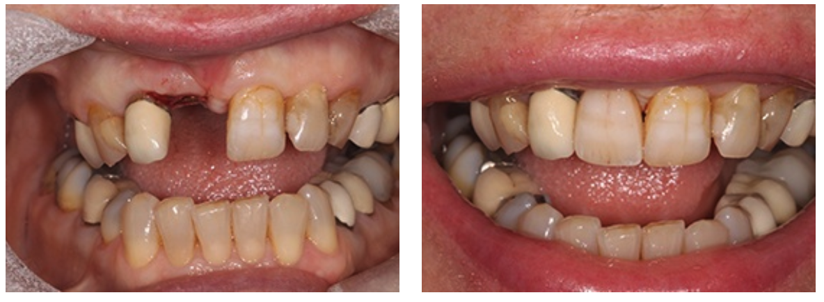 Dental client who was suffering from extreme tooth loss and decay