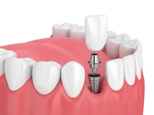 3d render of jaw with teeth and dental incisor implant over white background