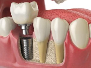 dental implants are a firm and stable way to replace missing teeth and are a popular alternative to dentures