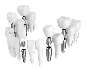 advanced Dental implants