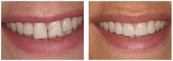 Veneer before and after