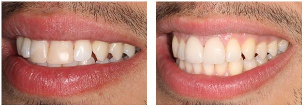 veneers are a popular choice for many patients in Roehampton