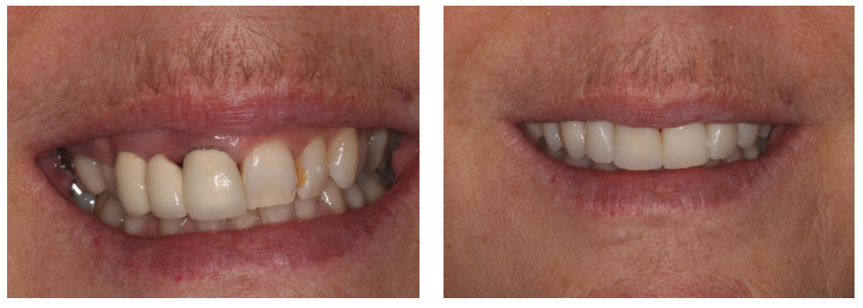 bridge and porcelain veneers before and after