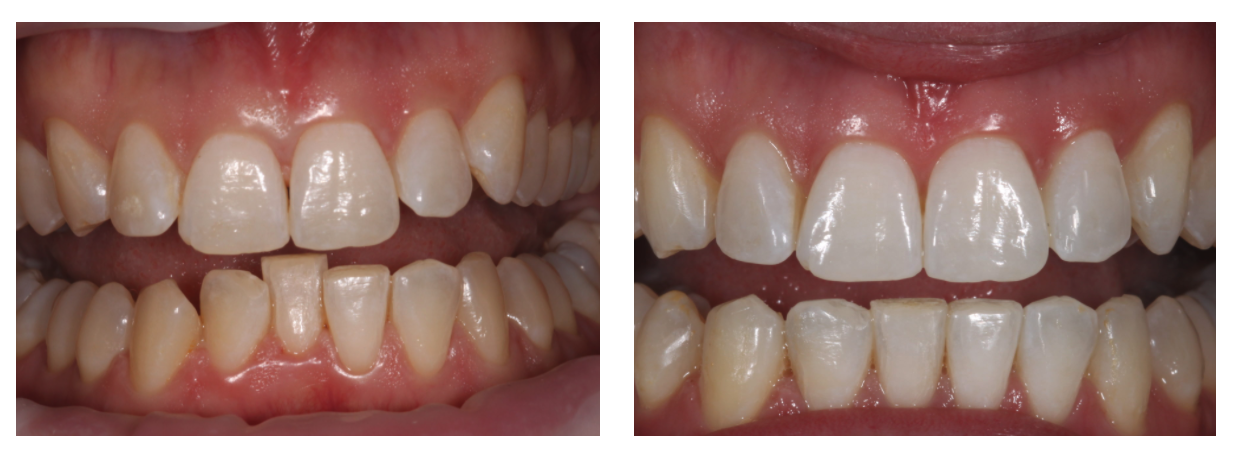 invisalign before and after