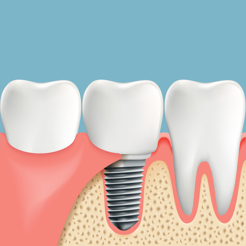 cheap dental implants