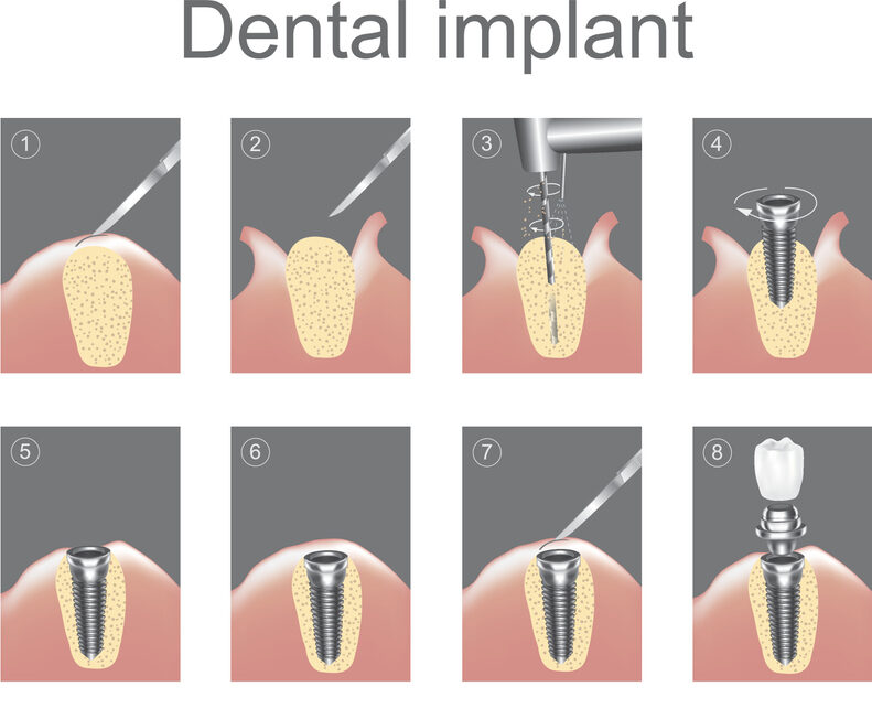 dental implant surgery