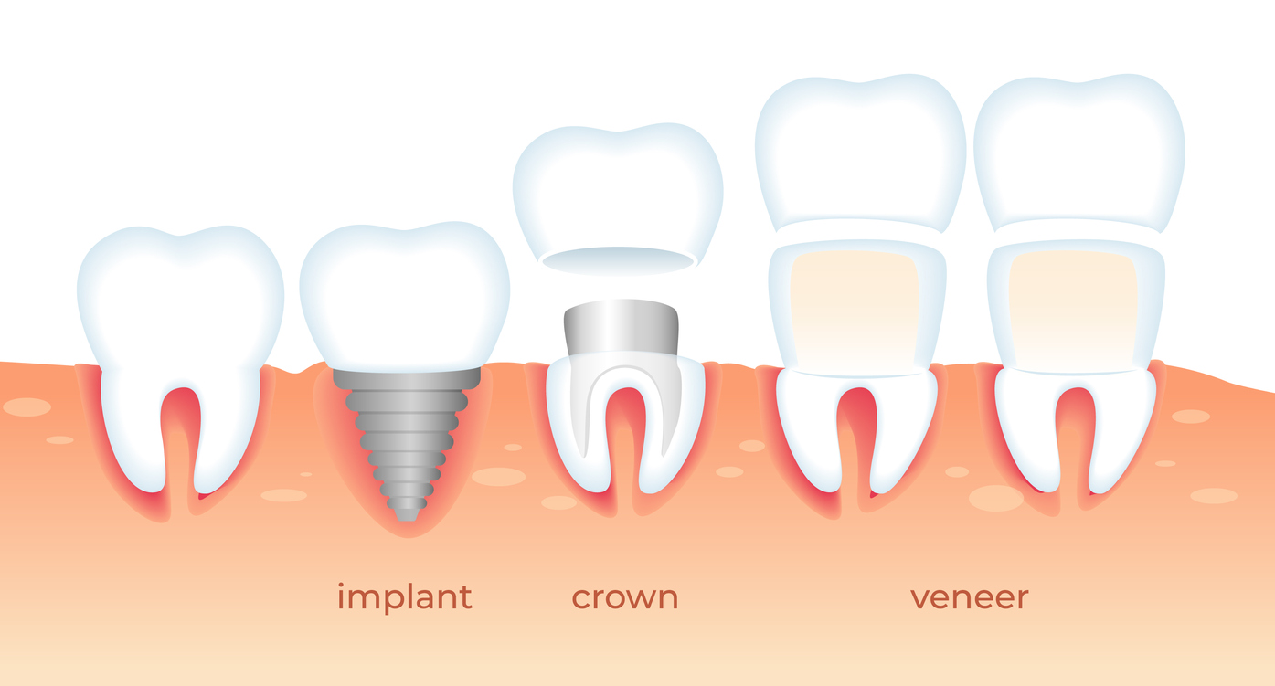 Palateless Dentures What The Dentist Says The Gentle Dental