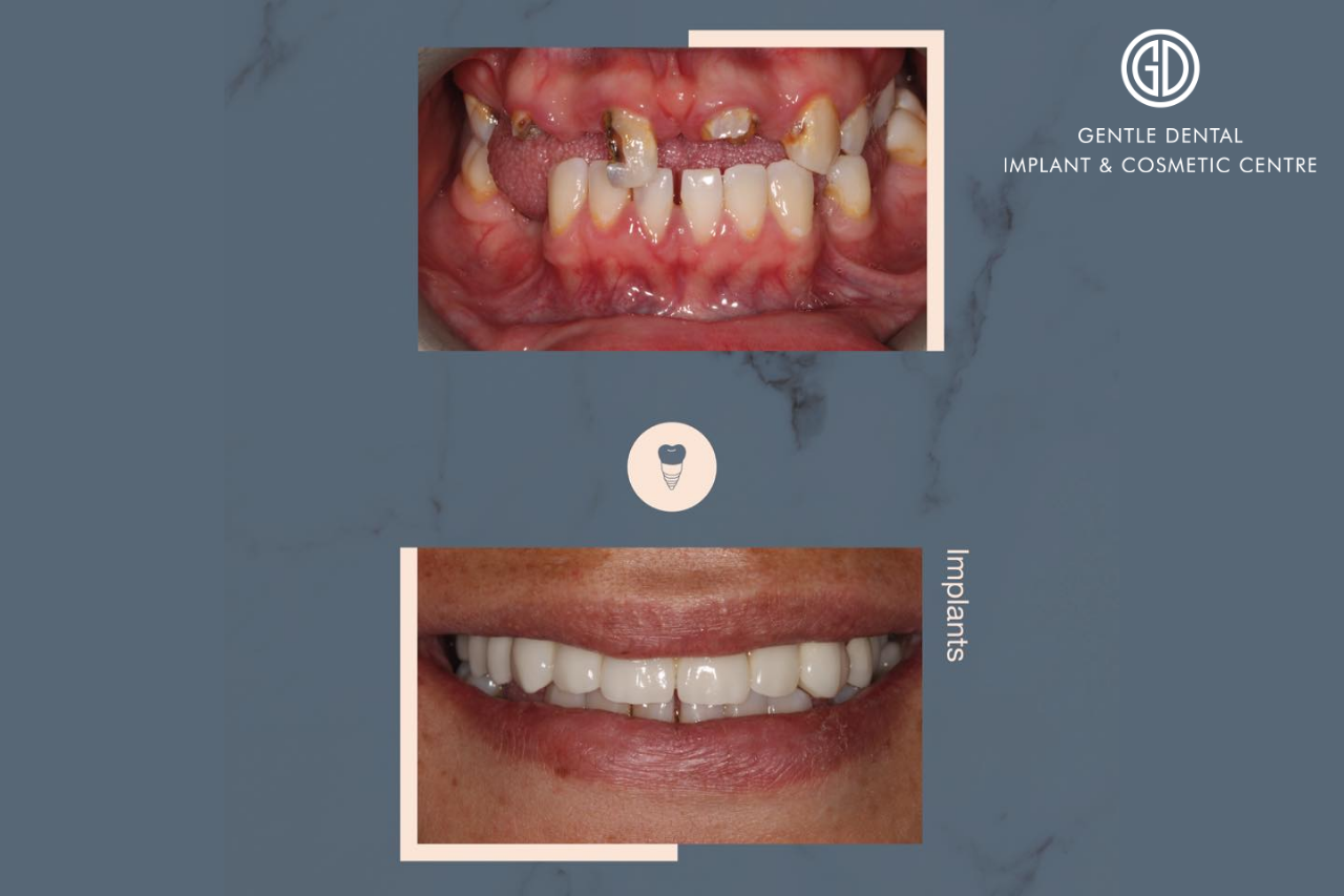 dental implants before and after