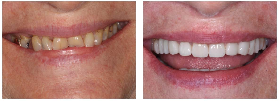 before-after-dental-implants