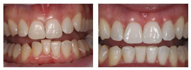 invisalign before and after