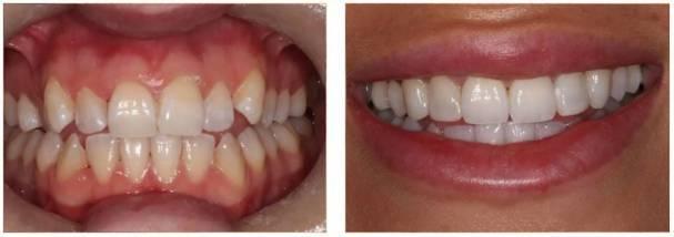 becky invisalign before and after