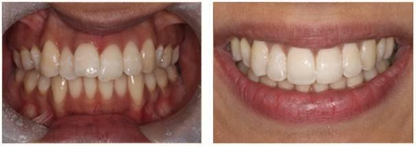 harry invisalign before and after