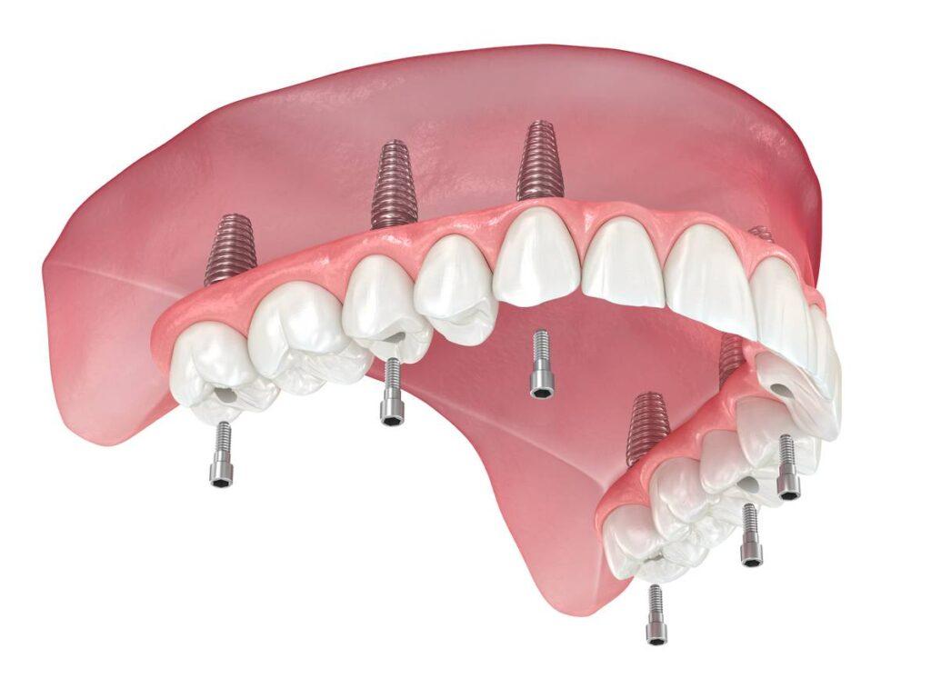 implant supported dentures