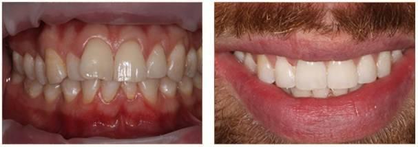 jack invisalign before and after