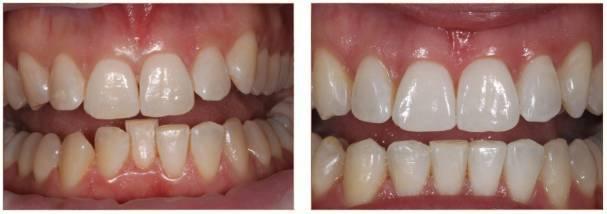 jane invisalign before and after