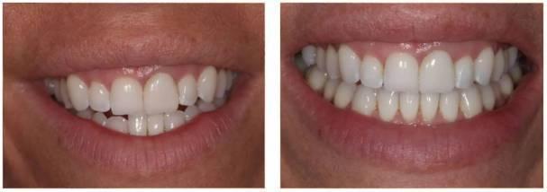 jenny invisalign before and after