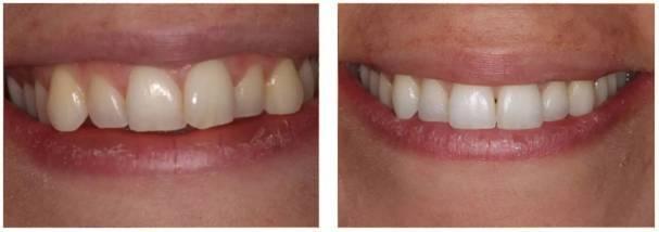 lauren invisalign before and after