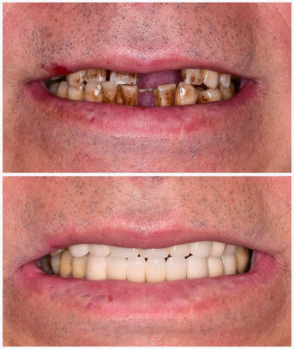 partial denture before and after