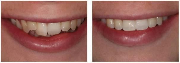 rebecca invisalign before and after