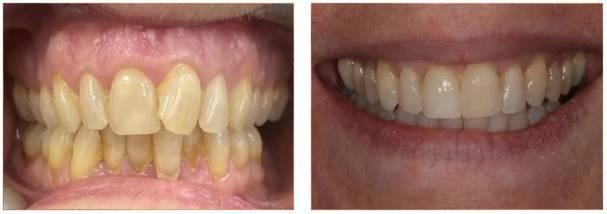 sandra invisalign before and after